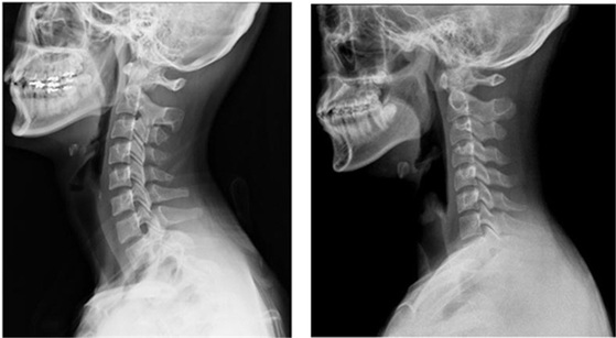 정상적인 C자형 목뼈(왼쪽)와 거북목(일자목).