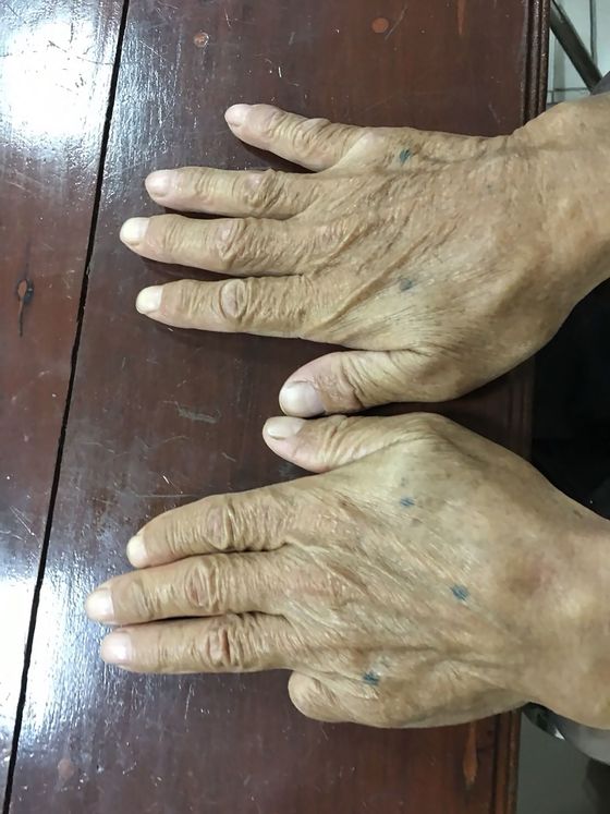 왼쪽 새끼손가락이 잘려나간 시라이의 손. [AFP=연합뉴스]