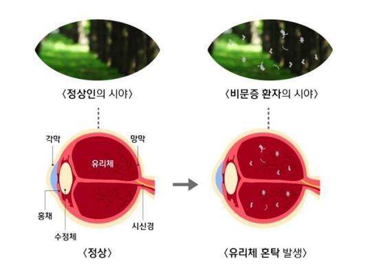 정상인의 시야와 비문증 환자의 시야. [사진 건강보험심사평가원 블로그 캡쳐]