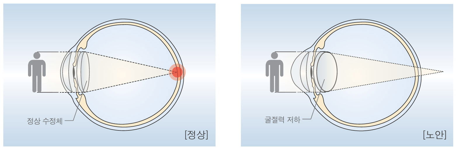 노안과 정상 눈 비교. [중앙포토]