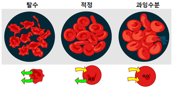 탈수로 삼투압 높아지면 세포가 수축한다(왼쪽). 물이 너무 많으면 세포팽창과 저나트륨증을 유발한다(오른쪽). 가운데는 정상 상태.