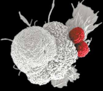 제3세대 면역항암제. 외부에서 키워지거나 주사로 강해진 면역T세포(적색)가 구강암세포(회색)에 달라붙어 파괴한다.