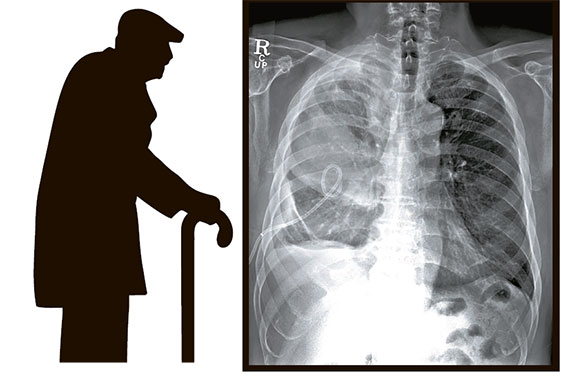 중증 폐렴을 앓고 있는 79세 남성의 흉부 엑스레이. 정상적인 폐는 양쪽 다 검게 나타나지만 폐렴이 진행되면 사진 속 폐의 왼쪽과 같이 희게 나타난다. 폐왼쪽에 보이는 흰 선은 염증으로 인해 폐에 찬 물을 빼기 위해 삽입한 배액관이다. [사진 세브란스병원]