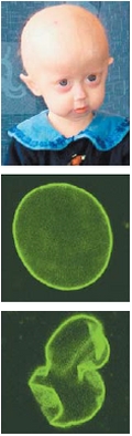 선천성 조로증.핵막 유전자 이상으로 비정상 핵막 (아래녹색 부분)이 생겨 노화가 7~8배 빠르다.