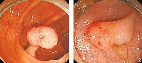 1 대장 선종(암이 될 가능성이 큼). 2 대장 증식성용종(암 가능성 거의 없음). 사진=삼성서울병원