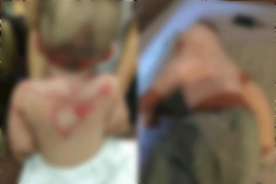 2015년 1월 전북 정읍의 한 어린이집에서 화상 사고를 입은 영아. 경기 시흥 어린이집 사고와 마찬가지로 커피포트 사용 부주의로 일어났다.[사진 온라인 커뮤니티 캡처]