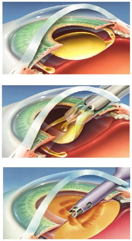   A cataract surgery procedure in which a cloudy lens is crushed (top), then the lens is inserted (inserted) and the intraocular lens (lower) is inserted. [중앙포토]