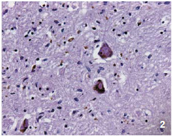 2 파킨슨 뇌세포(흑질부위) 루이소체(갈색, 알파큐늘레인 단백질엉김체)