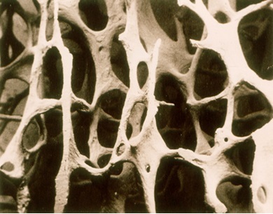 골다공증 뼈의 단면을 확대해 보면 구멍이 많고 커서 앙상한 나뭇가지 모양이다. [중앙포토]