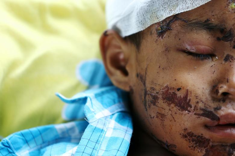 지난 10월 발생한 인도네시아 술라웨시 강진으로 큰 상처를 입은 한 아이가 인도네시아 팔루의 한 병원에서 눈물을 흘리고 있다. [로이터=연합뉴스]