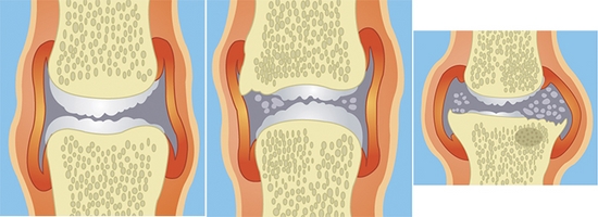퇴행성무릎관절염의 초기·중기·말기 모습. 연골이 닮아 찢어지고 너덜너덜해져 연골 표면이 울퉁불퉁해진다. 떨어져 나간 연골 조각이 윤활액 속에 떠다니기도 한다. 힘찬병원 제공  