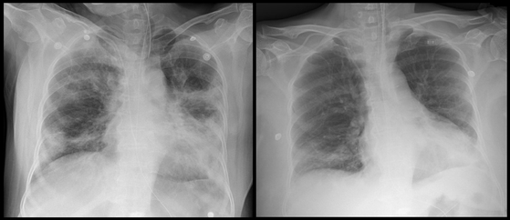세브란스병원이 혈장치료로 완치한 환자 이모씨의 폐 사진. 이씨가 혈장치료를 받기 전(좌)과 후(우)의 흉부 X-ray 영상. [사진 세브란스병원]