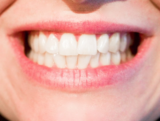 미국에서 코로나19 이후 치아에 금이 가거나 깨지는 치아균열증후군 환자가 늘었다는 보도가 나왔다. [pixabay]