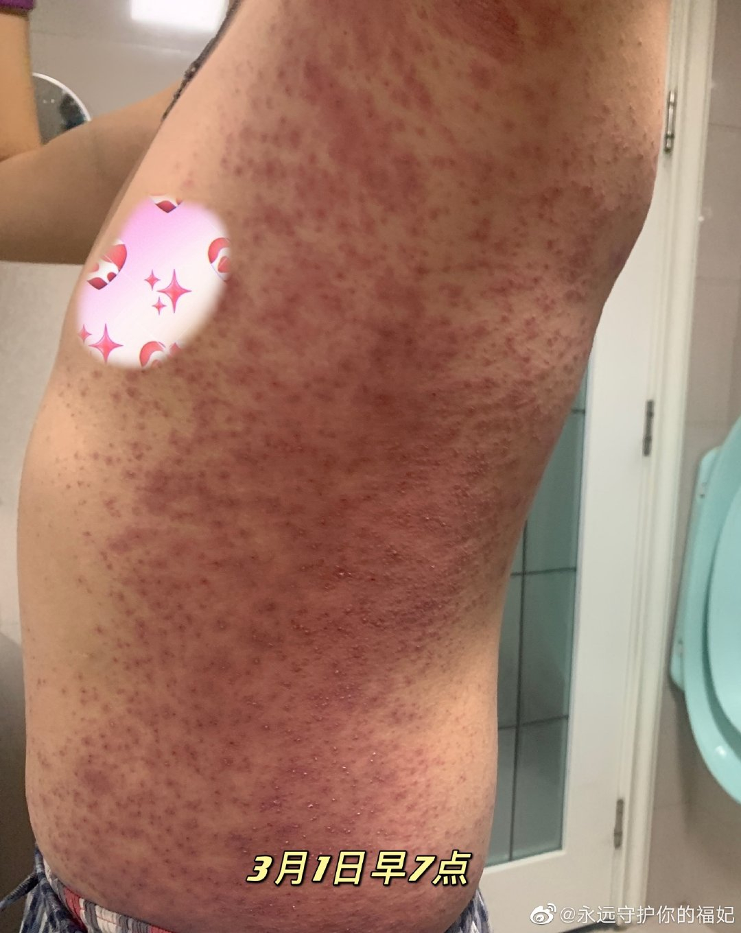 “시노 팜 백신 접종 후 전신 붉은 반점”사진