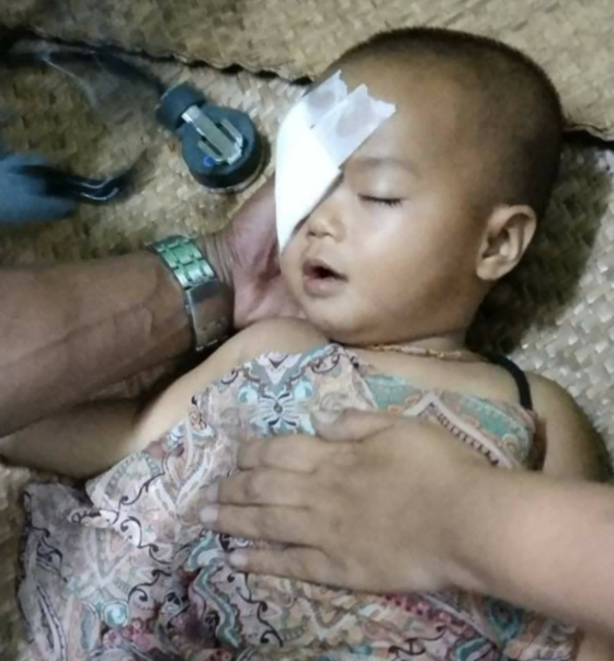 A one-year-old girl wrapped in bandages after being hit by a rubber bullet from the military police near Yangon on the 27th. [사진 미얀마 나우 트위터]