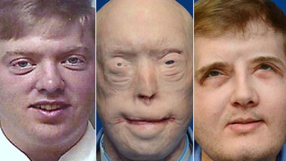 하디슨이 다치기 전(맨 왼쪽), 사고직후 수술을 받은 모습(가운데), 안면 이식수술을 받은 후의 모습. [사진 랭곤의료원]