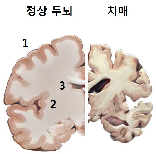 치매 환자. 정상(왼쪽) 에 비해 뇌세포가 죽어 위축됐다. 종합사고담당 대뇌피질①, 단기기억 해마②)가 졸아들었고 뇌 사이 공간③이 넓어졌다.